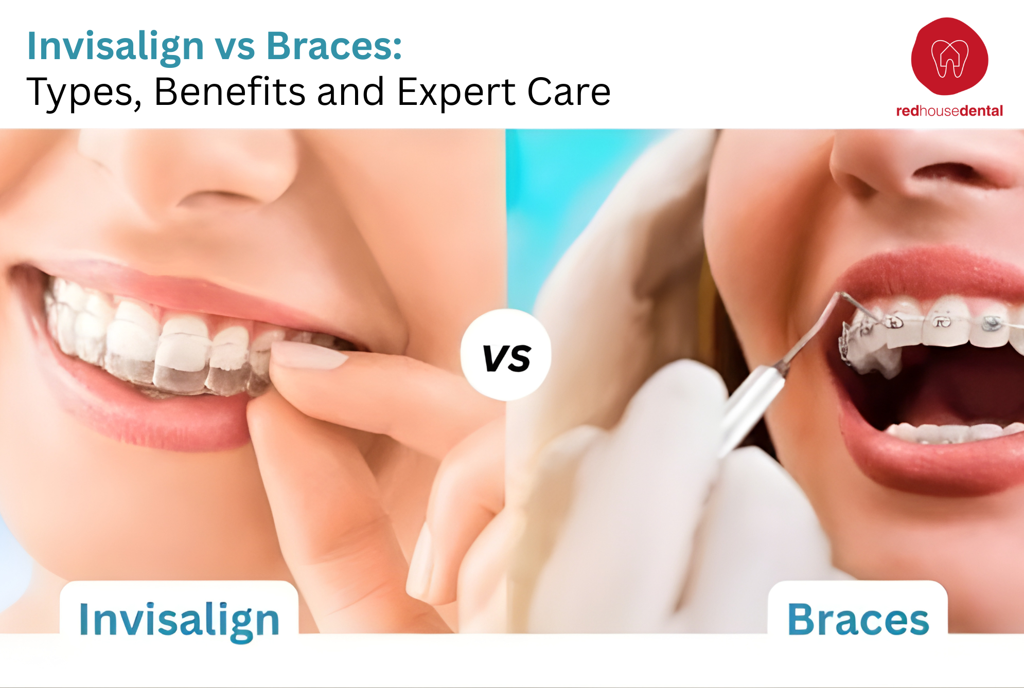 Invisalign vs Braces