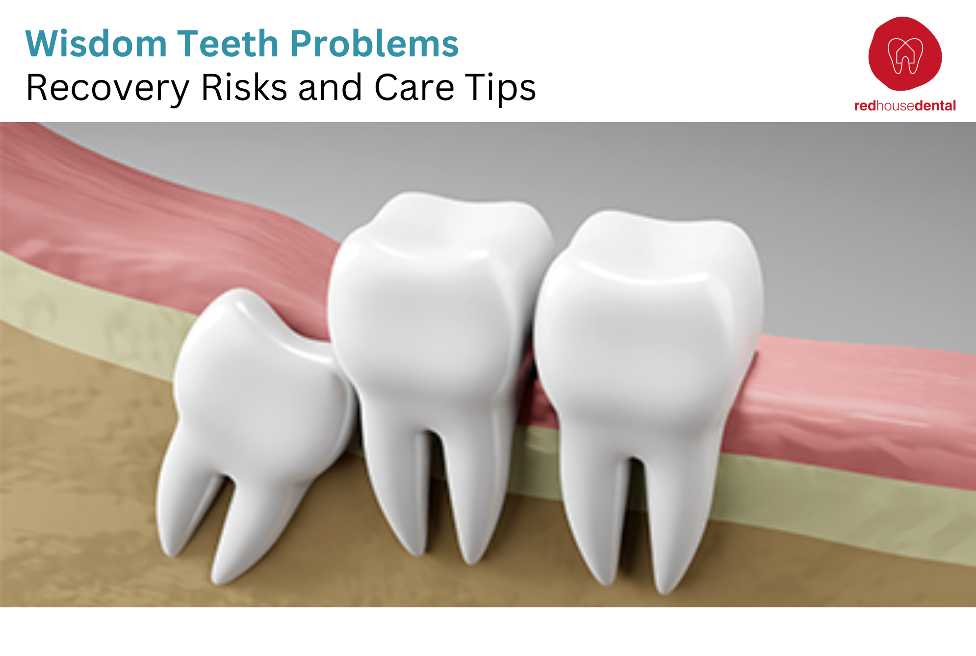 Wisdom Teeth Problems
