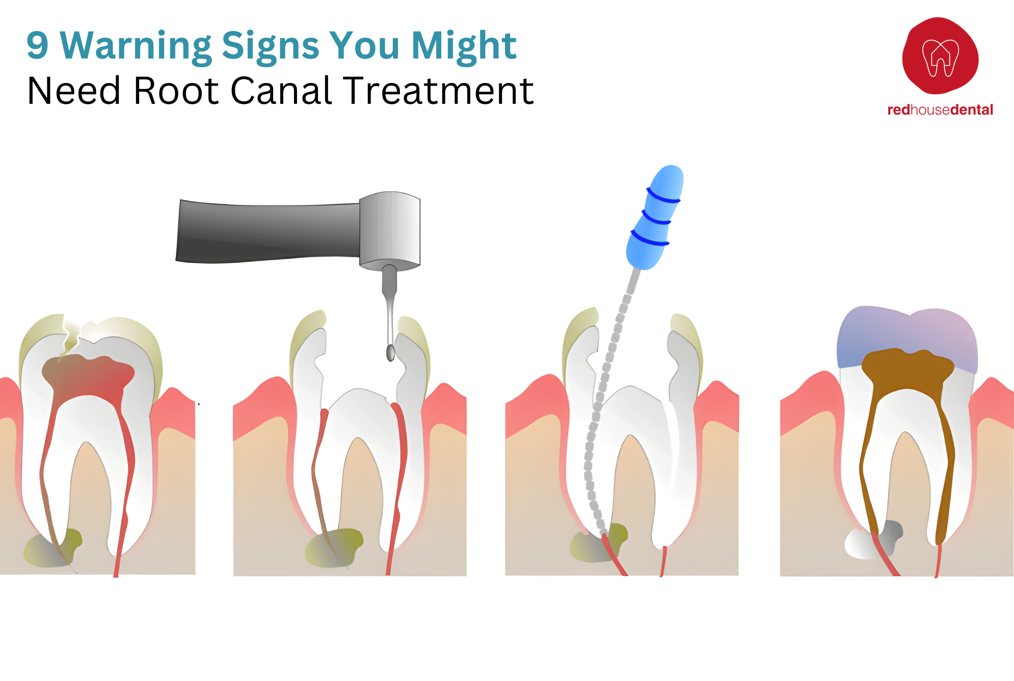 9 Warning Signs You Might Need a Root Canal Treatment