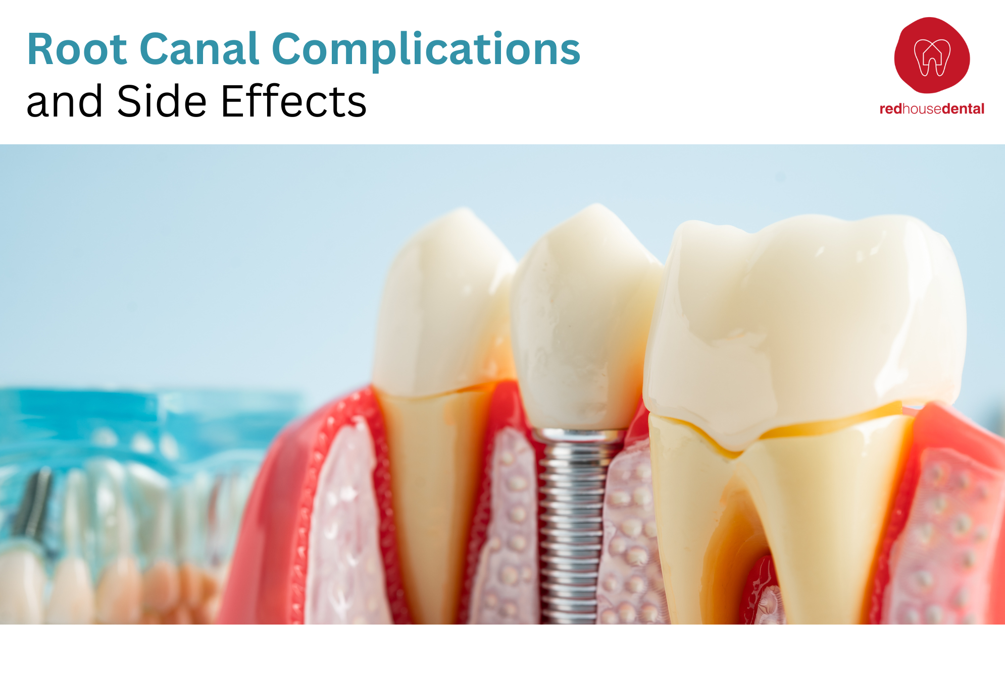 Root Canal Complications & Side Effects