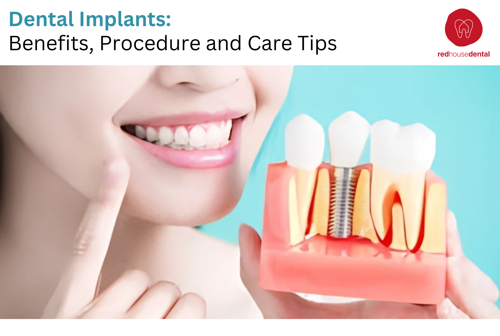 Dental Implants: Benefits, Procedure and Care Tips