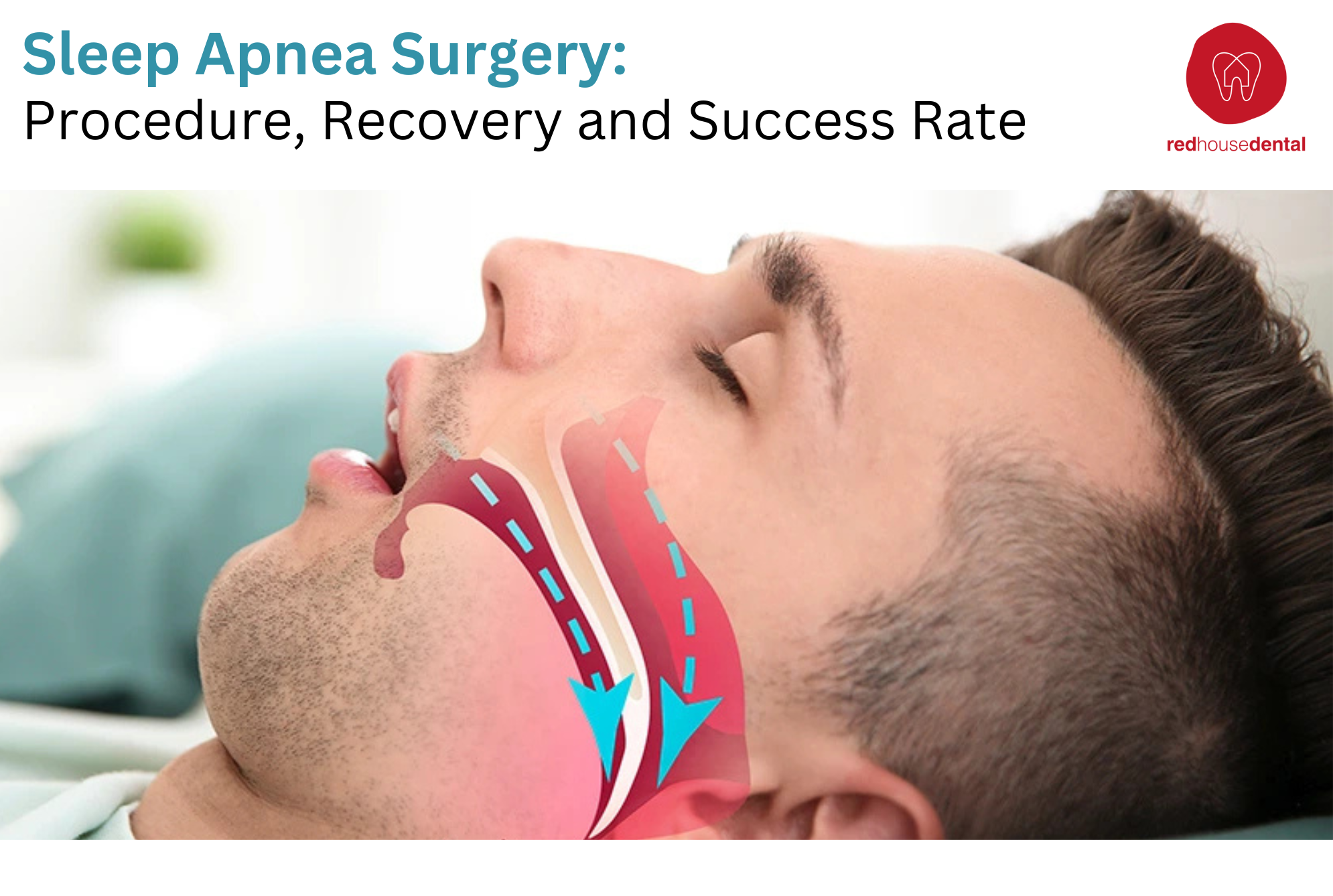 Sleep Apnea Surgery