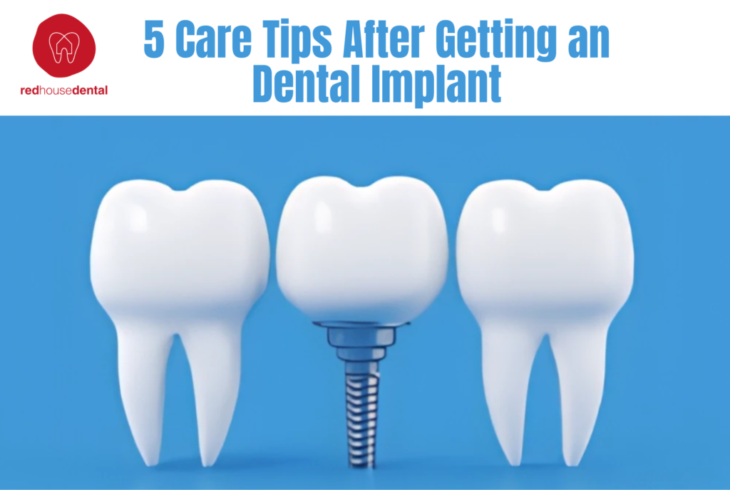 5 Care Tips After Getting an Implant
