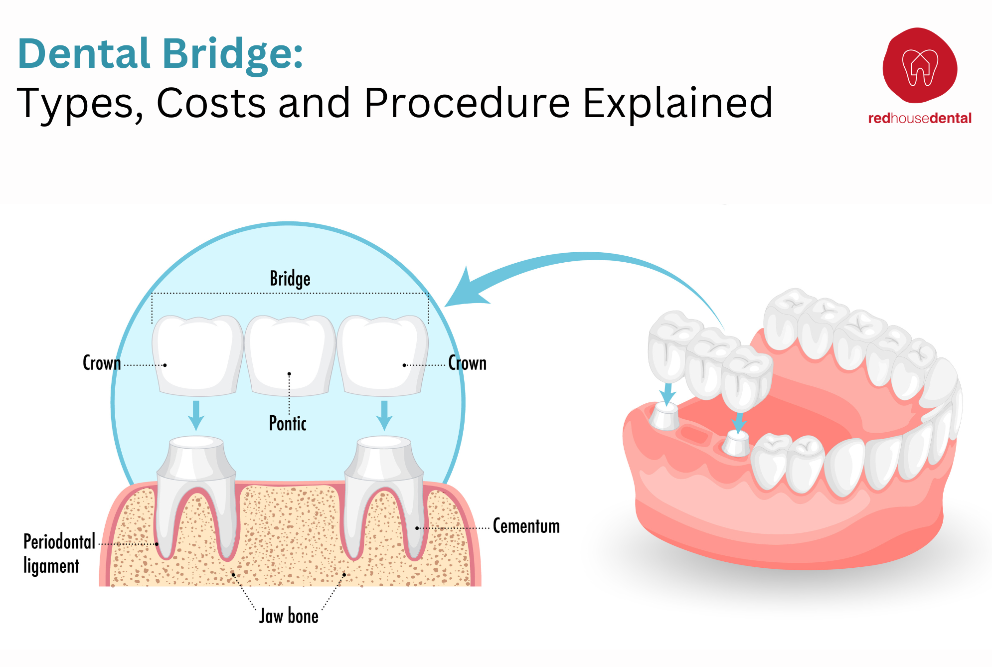 Dental Bridge