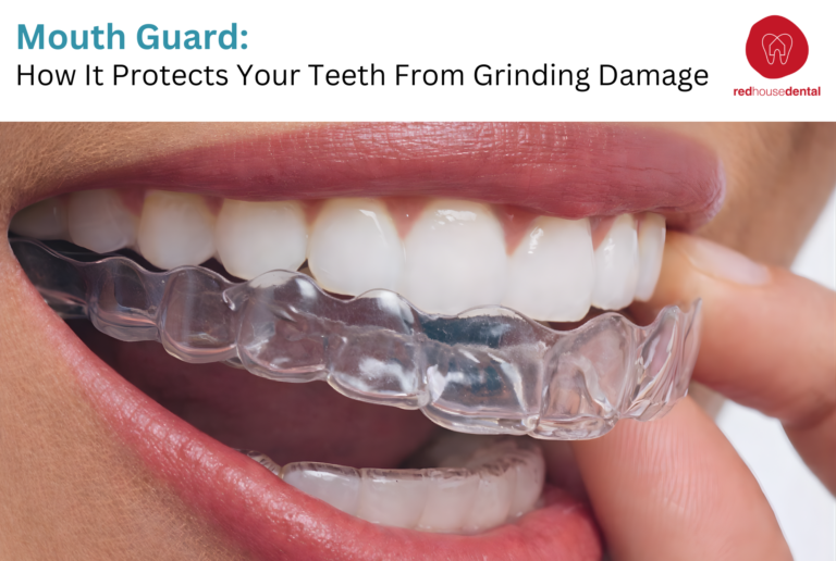 mouth guard