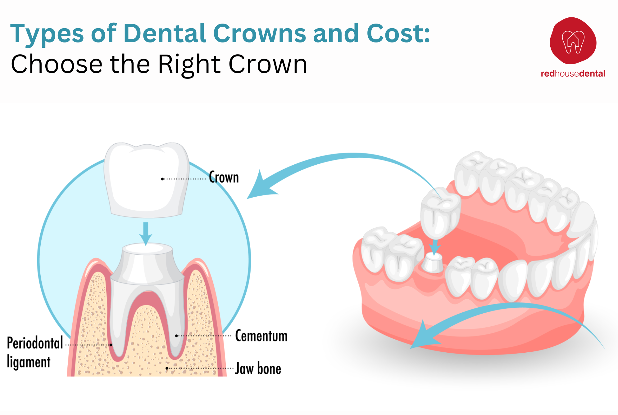 types of dental crowns and cost