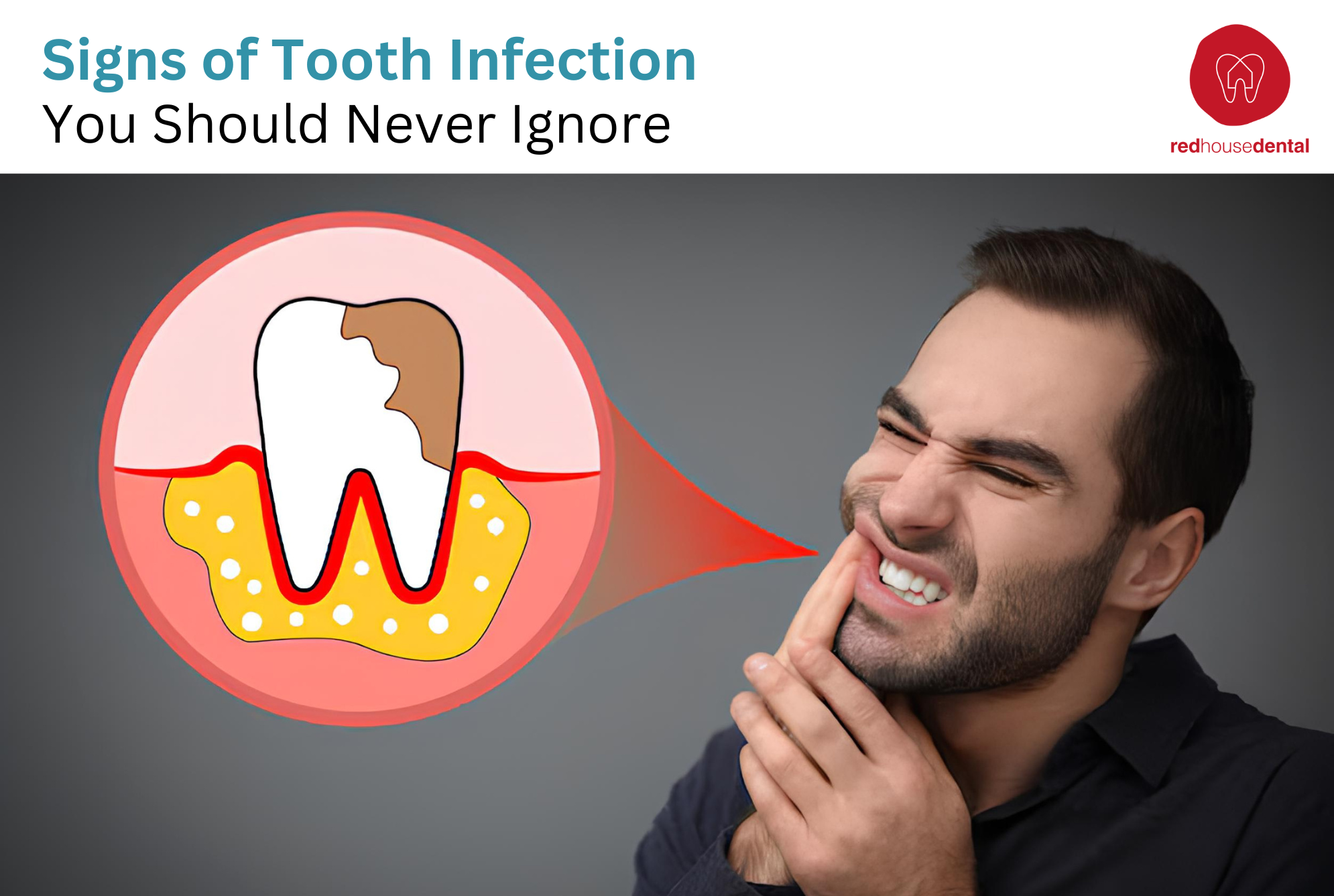 tooth infection