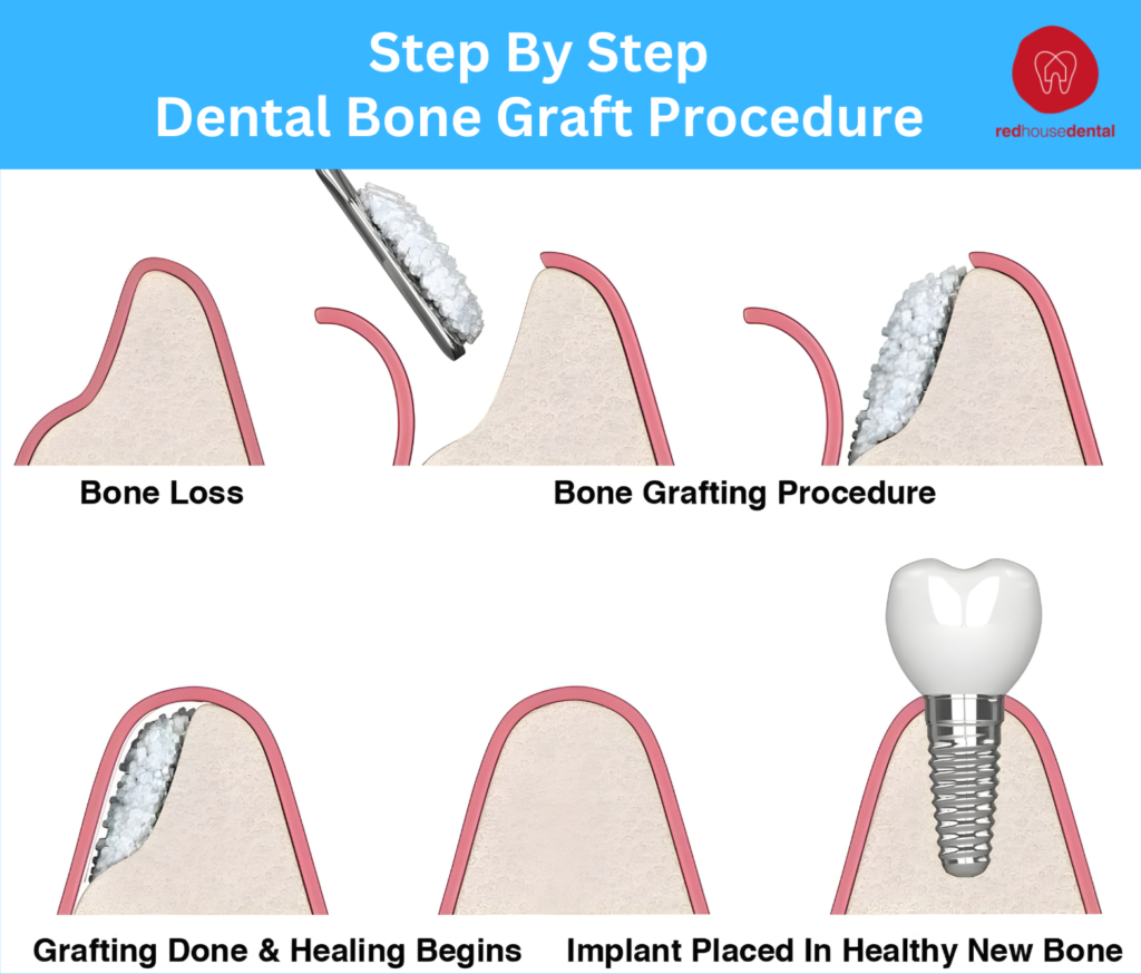 dental bone graft