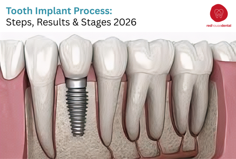 Tooth Implant Process: Steps, Results & Stages 2026