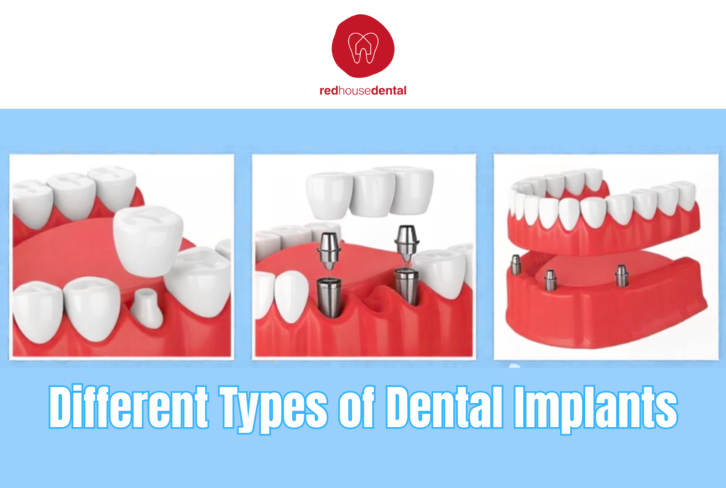 Tooth implant process
