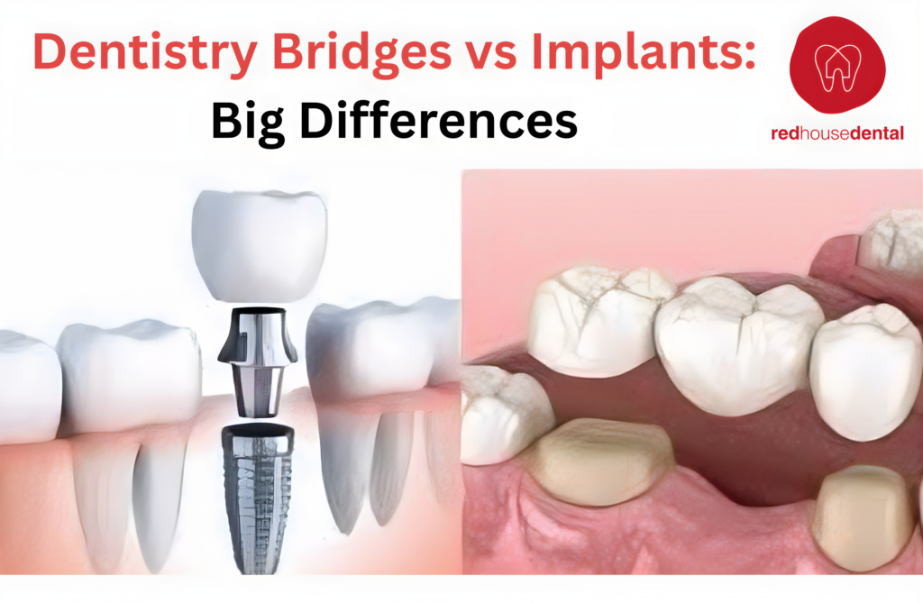 dentistry bridges vs implants