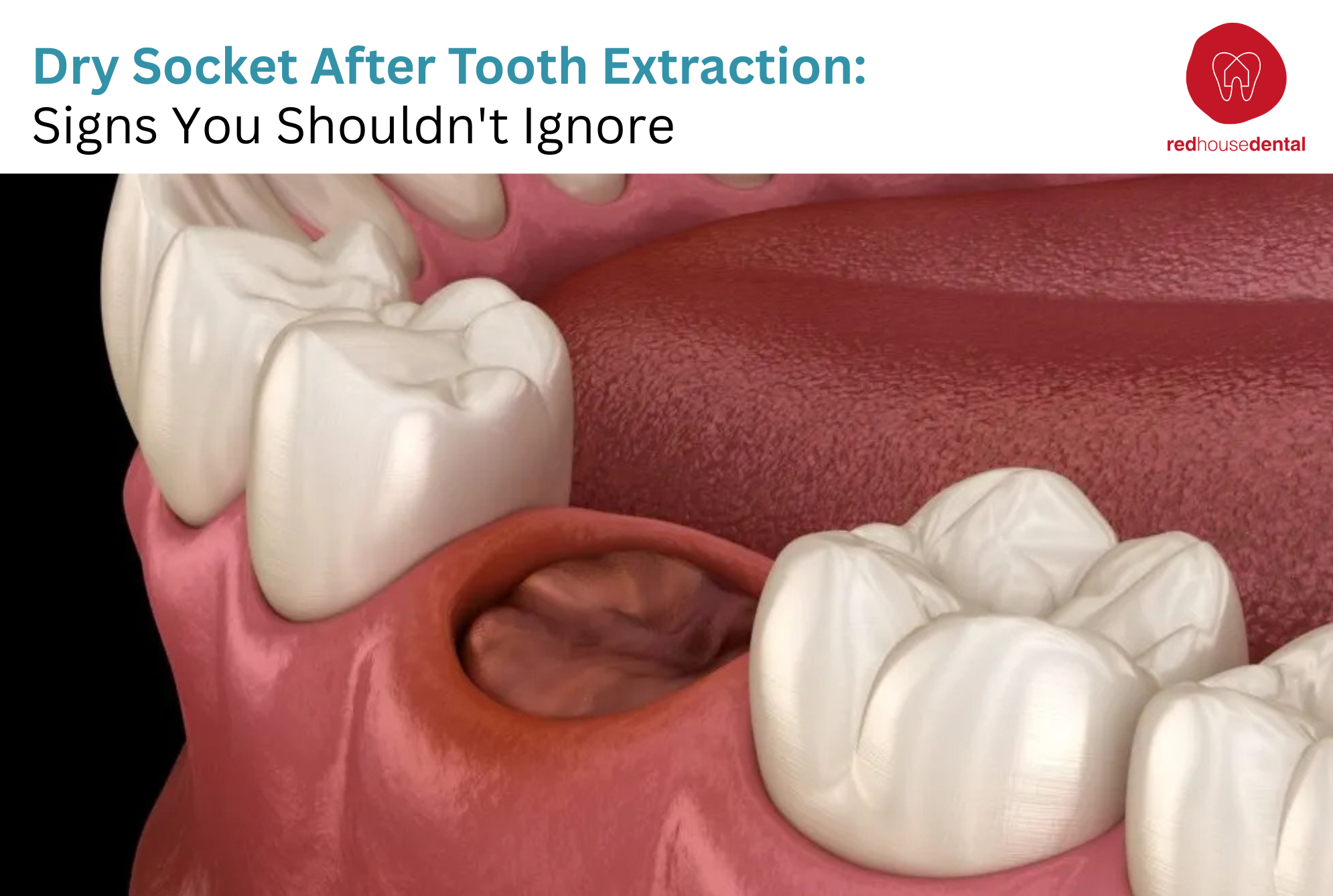Dry Socket After Tooth Extraction: Sign You Shouldn’t Ignore