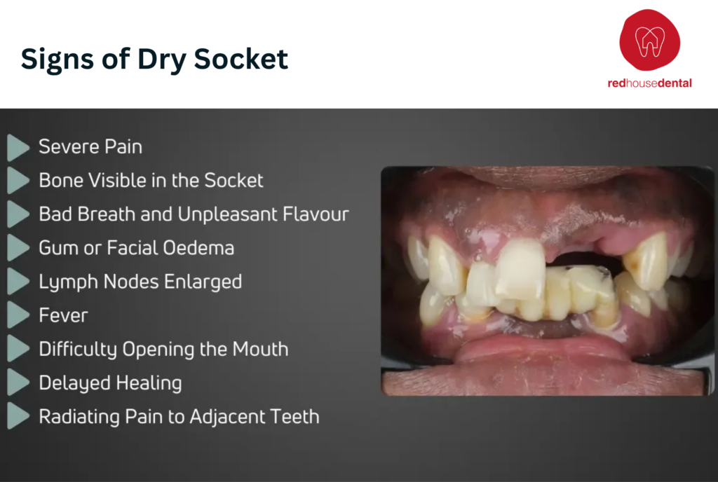 sign of dry socket
