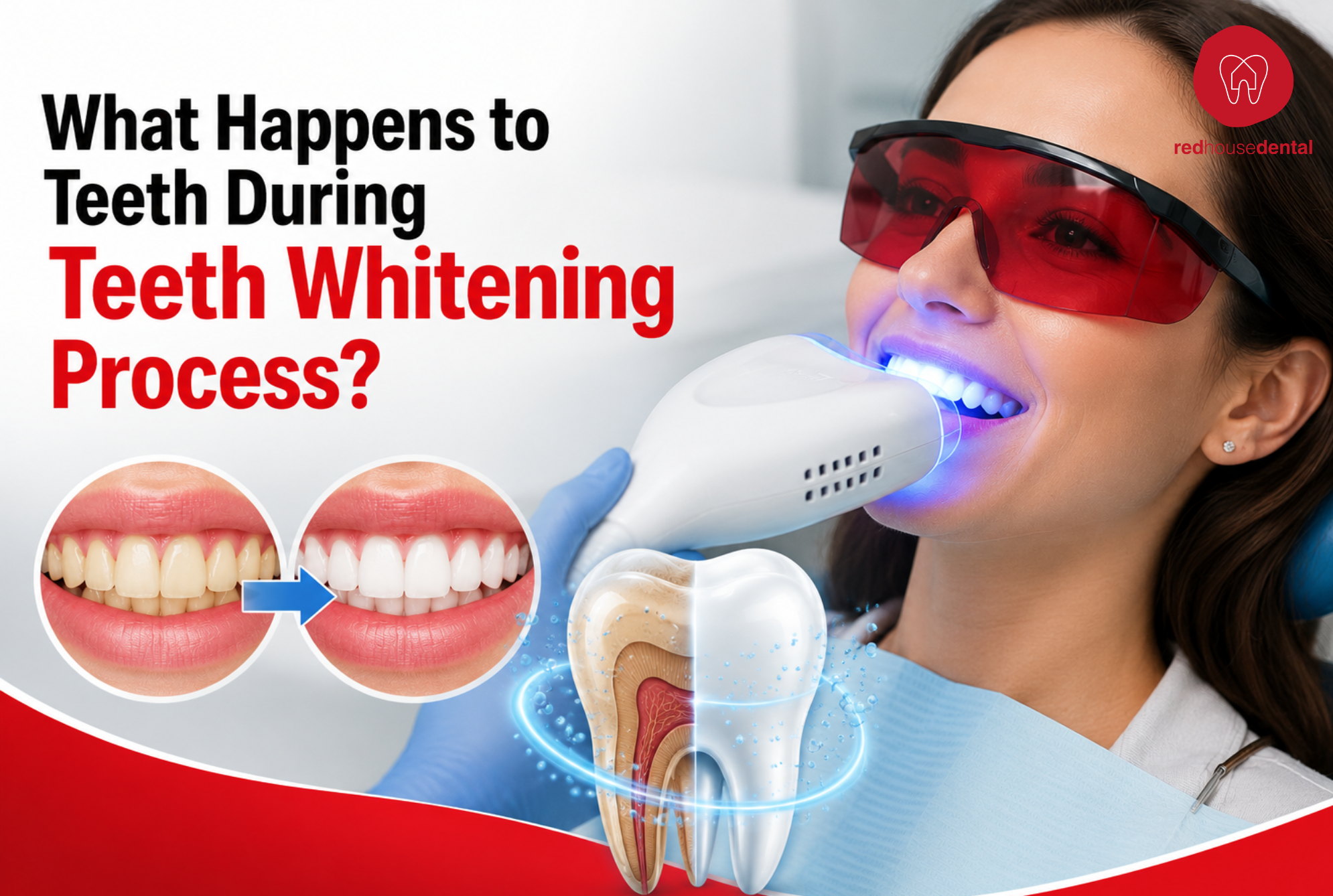 teeth whitening