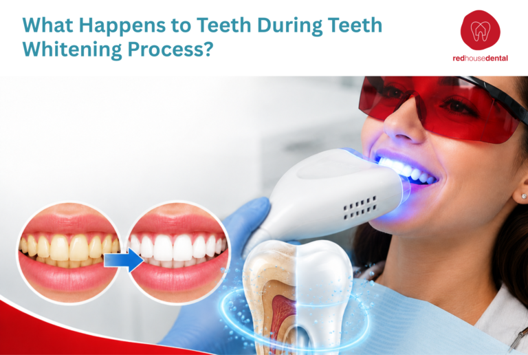 teeth whitening