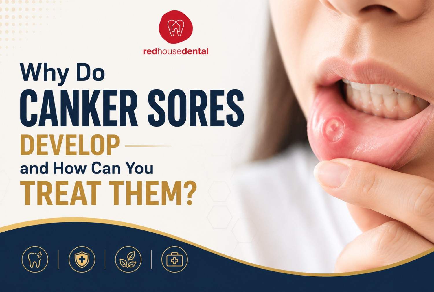 canker sore